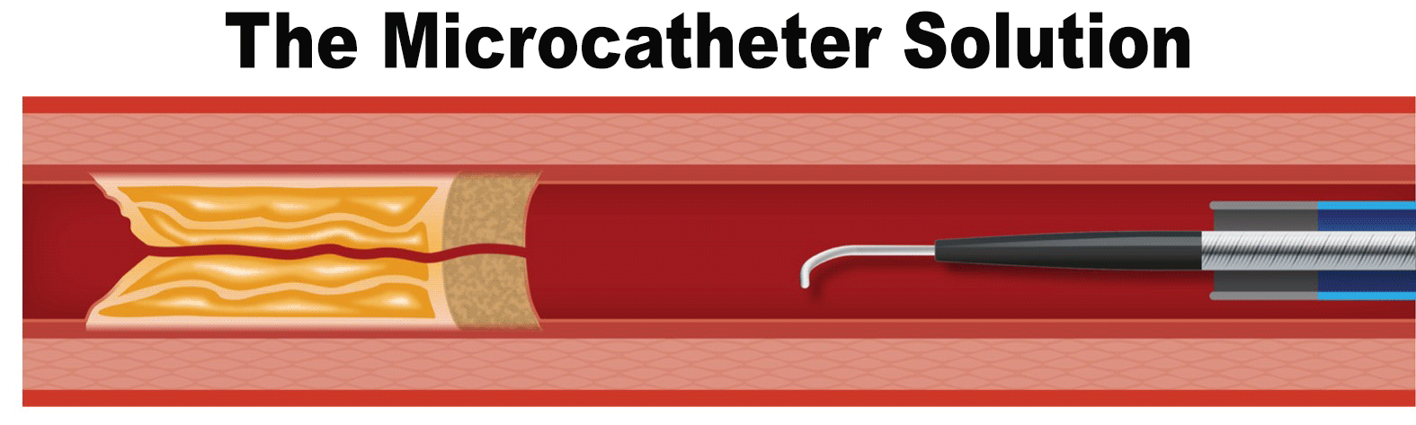 animated gif showing microcatheter with guide wire within allowing the guide wire to move through the tight lesion, then the microcatheter moves through the calicified lesion.