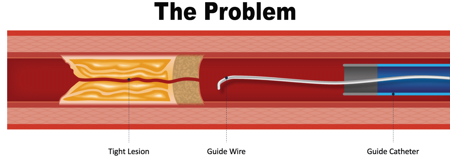 gif animation of guidewire moving through lesion and blocked by a tight and calcified lesion. The guidewire bends as it tries to push through