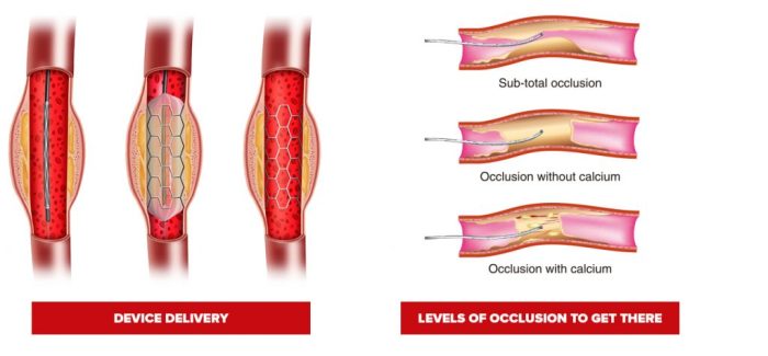 illustration of coronary guidewire in a lesion delivering a stent device on the left and the different levels of occlusion in a lesion preventing the passage of the guide wire on the right